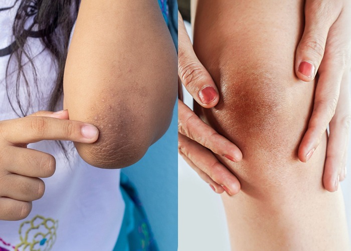 Dark Elbow Treatment