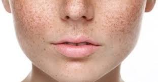 Pigmentation Treatment
