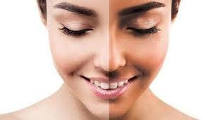 Skin Whitening Treatment